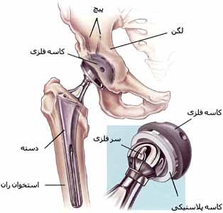 قسمت های مختلف مفصل مصنوعی لگن