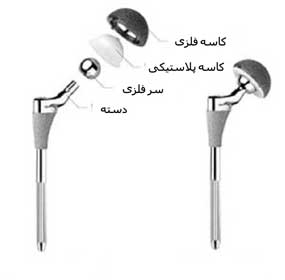 مفصل مصنوعی ران