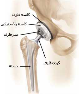 مفصل مصنوعی لگن