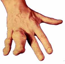  تغییر شکل انگشت به علت کندروم متعدد