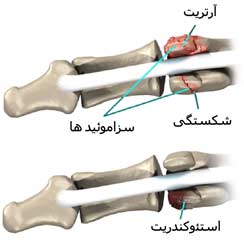 استخوان سزاموئید