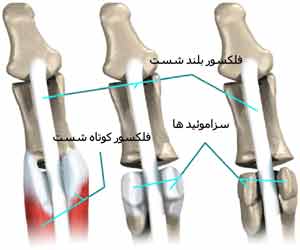 استخوان سزاموئید