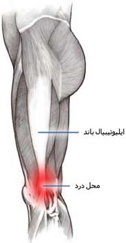 ایلیوتیبیال باند