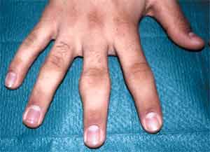  تورم مفصل اینترفالانژیال پرگزیمال انگشت سوم دست