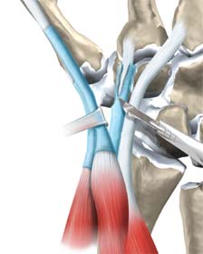  برداشتن غلاف تاندون ها در جراحی سندروم تقاطع
