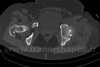 شکستگی سر استخوان ران در لگن