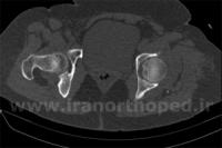 شکستگی سر استخوان ران در لگن