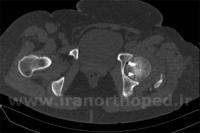 شکستگی سر استخوان ران در لگن