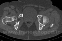 شکستگی سر استخوان ران در لگن