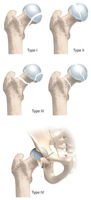 انواع شکستگی های سر استخوان ران