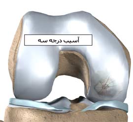 آسیب غضروف زانو