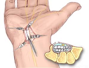 جراحی سندورم کانال کارپ