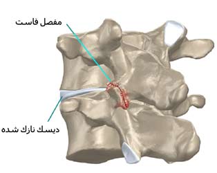 آرتروز مفصل فاست بدنبال نازک شدن دیسک بین مهره ای