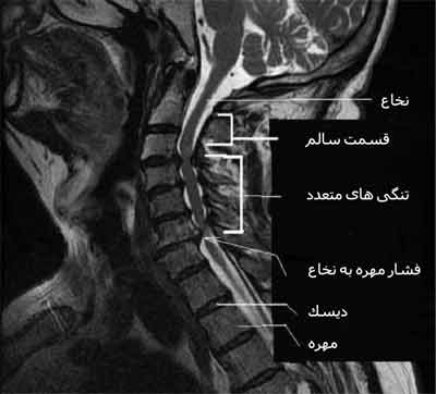 تنگی کانال نخاع گردن