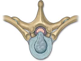  جابجایی و فتق دیسک بین مهره ای و فشار به نخاع