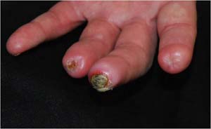  نکروز و سیاه شدن نوک انگشتان در بیماری رینود