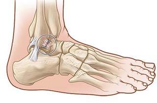 آسیب رباط جانبی خارجی در مچ پا