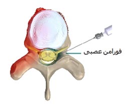  تزریق به فضای اپیدورال از طریق فورامن عصبی