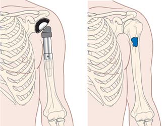 کارگذاری پروتز شانه بعد از خروج تومور