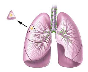 خروج متاستاز ریوی تومور