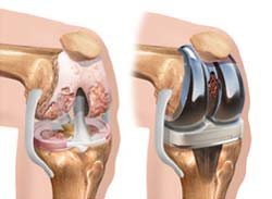 تعویض مفصل زانو