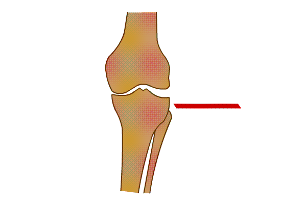  استئوتومی بسته بالای استخوان ساق برای اصلاح پای پرانتزی