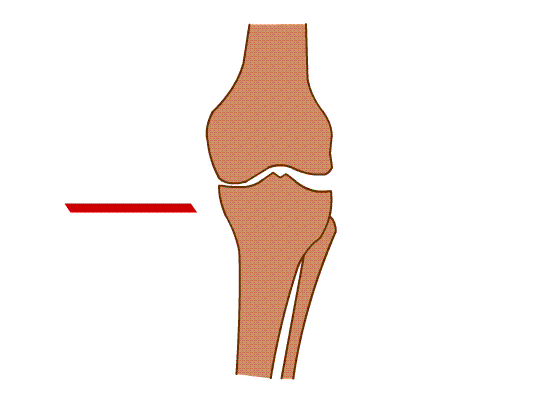 استئوتومی باز بالای استخوان ساق برای اصلاح پای پرانتزی